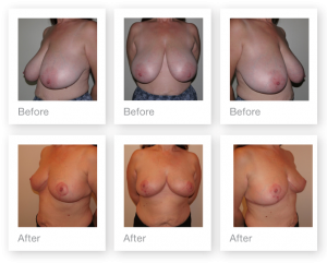 Chris Stone Breast Reduction surgery before & after surgery October 2017