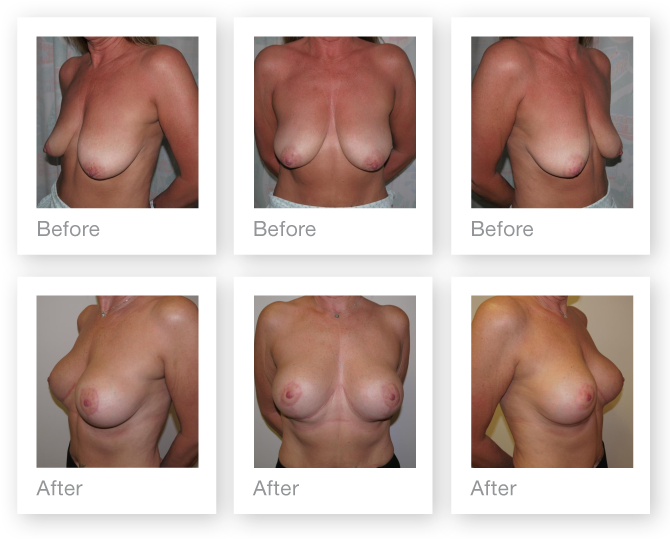 breast mastopexy & augmentation surgery before & after by Cosmetic Surgeon Christopher Stone October 2015