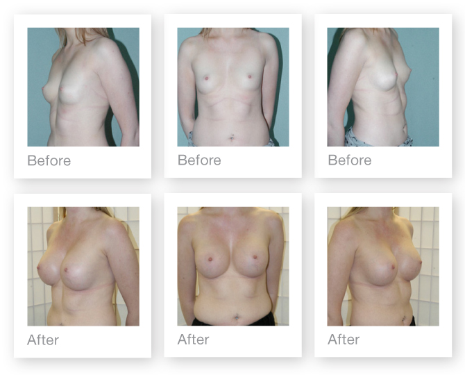 Breast Augmentation (boob job) 2 surgery before & after by Chris Stone Surgeon
