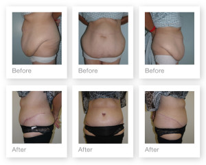 Abdominoplasty by Surgeon Chris Stone in September 2013