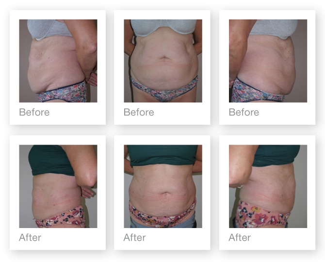 Exeter Liposuction surgery pre and post op by Cosmetic Surgeon Chris Stone