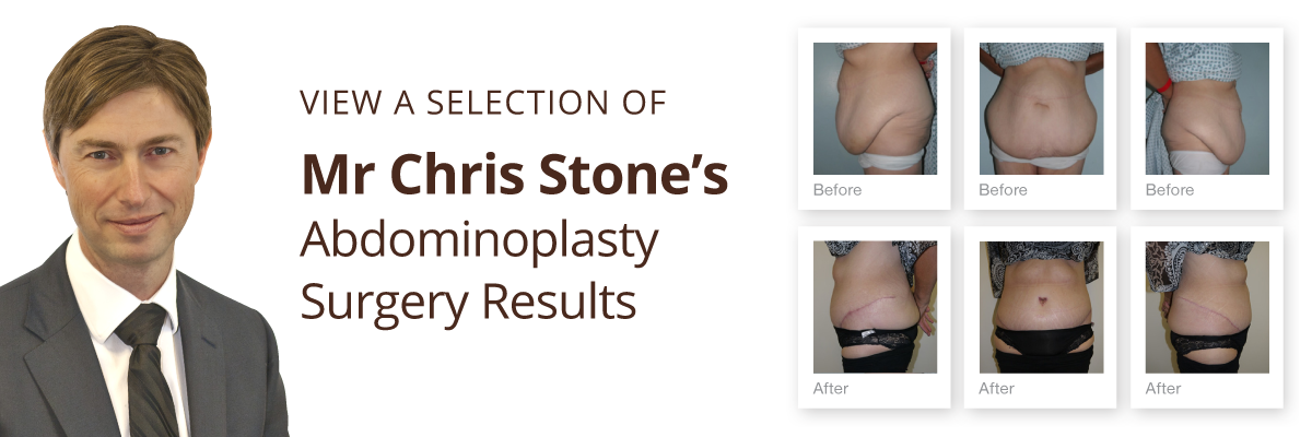 Exeter Cosmetic Surgery view abdominoplasty before & after results by Mr Chris Stone