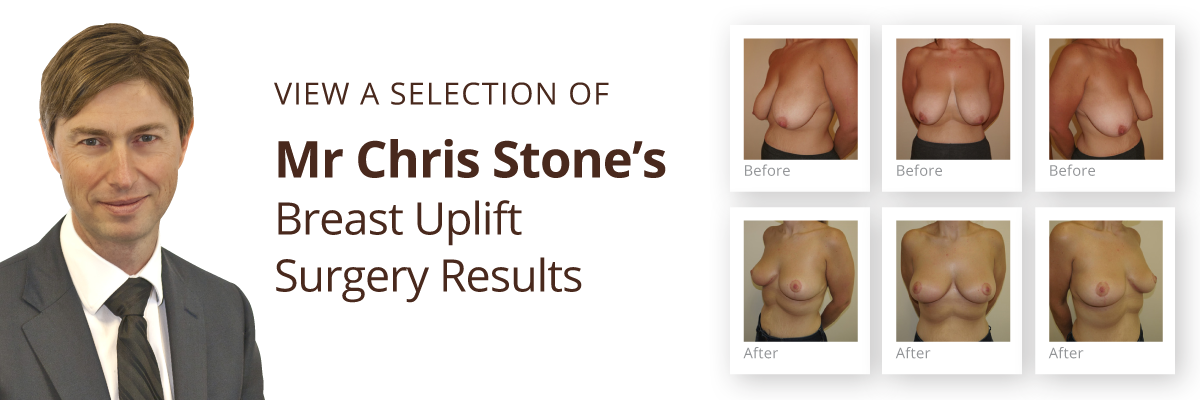 Exeter Cosmetic Surgery view breast uplift before & after results by Mr Chris Stone