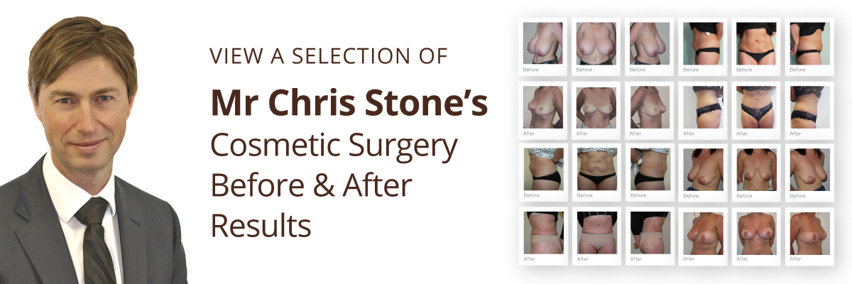 Exeter Cosmetic Surgery view cosmetic surgery before & after results by Mr Chris Stone