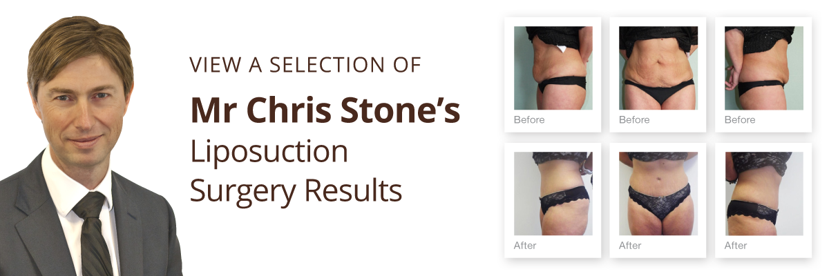 Exeter Cosmetic Surgery view liposuction before & after results by Mr Chris Stone