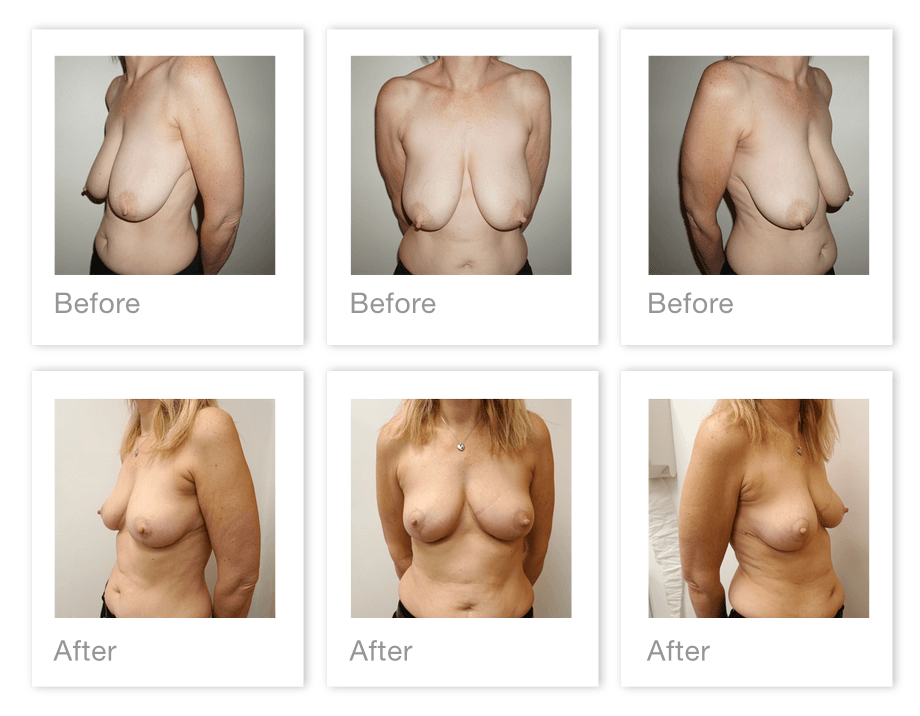 Chris Stone Exeter Breast Reduction surgery before & after Feb 2020